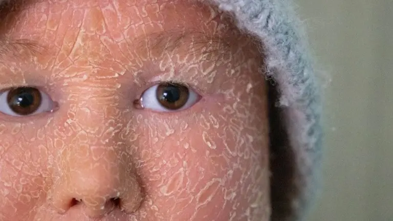 Carmen Posadas visibiliza la ictiosis arlequ&iacute;n  en las nuevas bolsas para farmacias de Cinfa. CEDIDA