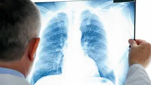 Una nueva inmunoterapia combinada e investigada en Pamplona podría mejorar el tratamiento del cáncer de pulmón