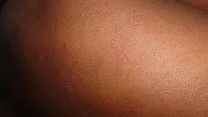 Nueva alerta sanitaria: detectados tres casos de sarampión en personas no vacunadas en el norte de Navarra