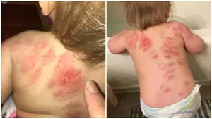 Un importante descuido: una madre recoge de la guardería a su bebé y se la encuentra llena de mordeduras