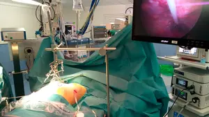 Un hospital navarro crea un pionero dispositivo para corregir la deformidad conocida como 'pecho hundido'