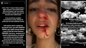 La pamplonesa agredida, entre una ola de apoyos y acusaciones de fraude: "Como si yo hubiera hecho algo malo"