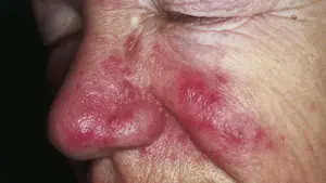 10 consejos para convivir con la rosácea en tiempos de mascarillas