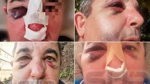 Operan al agente de Tudela agredido brutalmente en Zaragoza: "Tenía la mandíbula desprendida"