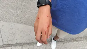 Un perro suelto muerde a un chico de 14 a&ntilde;os en Tudela y le provoca una herida en una mano