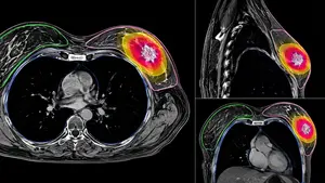 Una novedosa radioterapia logra controlar el c&aacute;ncer de mama en 122 pacientes de la Cl&iacute;nica Universidad de Navarra