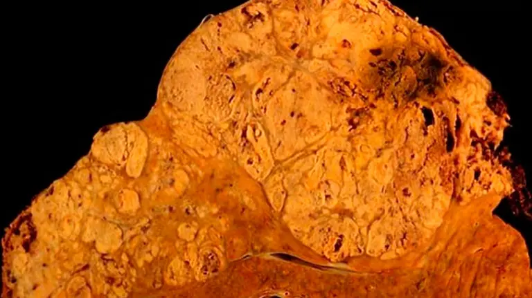 Hígado afectado por hepatitis C. EP