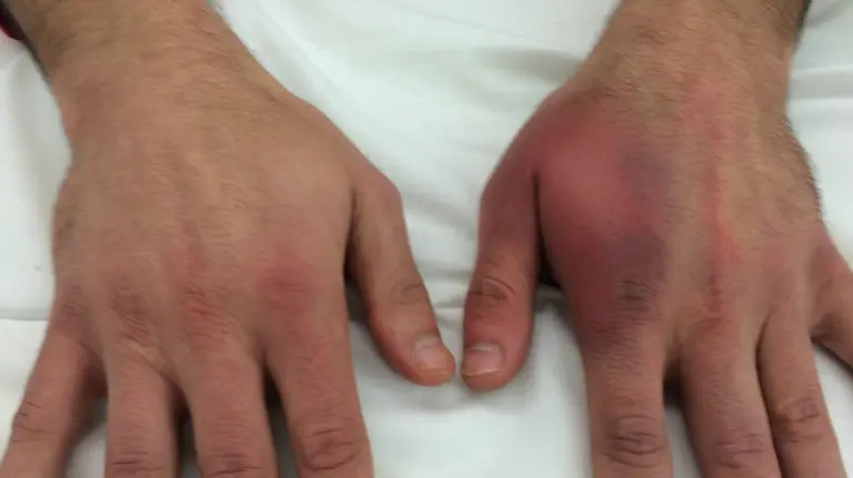 Imagen de la mano hinchada de irujo. Foto web de Aspe.