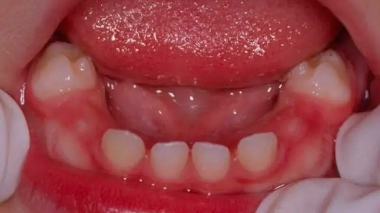 Dientes de leche. EP