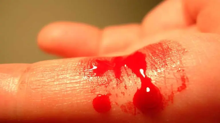 Mano sangrando por un corte. ARCHIVO