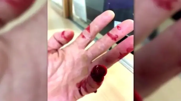 Arranca un dedo a un policía de un mordisco