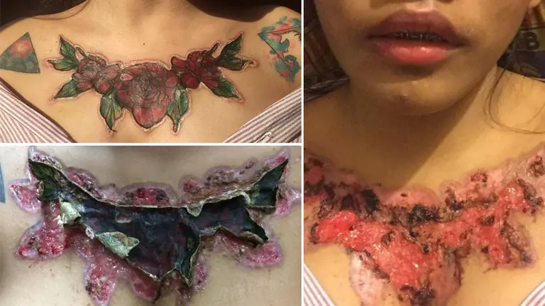 Im&aacute;genes de la joven tailandesa que se ha abrasado la piel tratando de retirarse por su cuenta un tatuaje en el pecho FACEBOOK