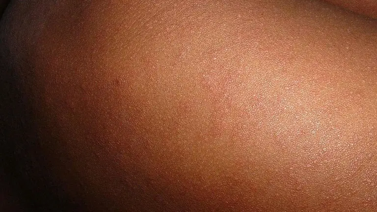 Una imagen de sarpullido, como el sarampión