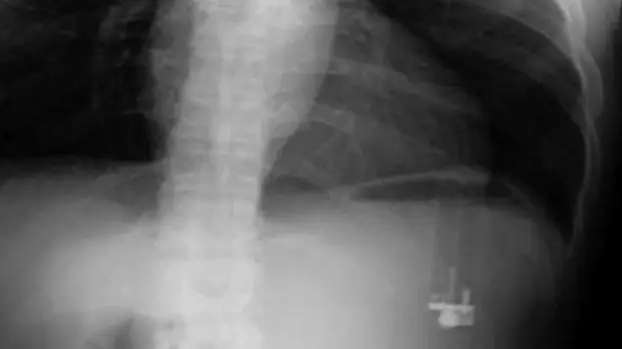 Un encendedor en el intestino