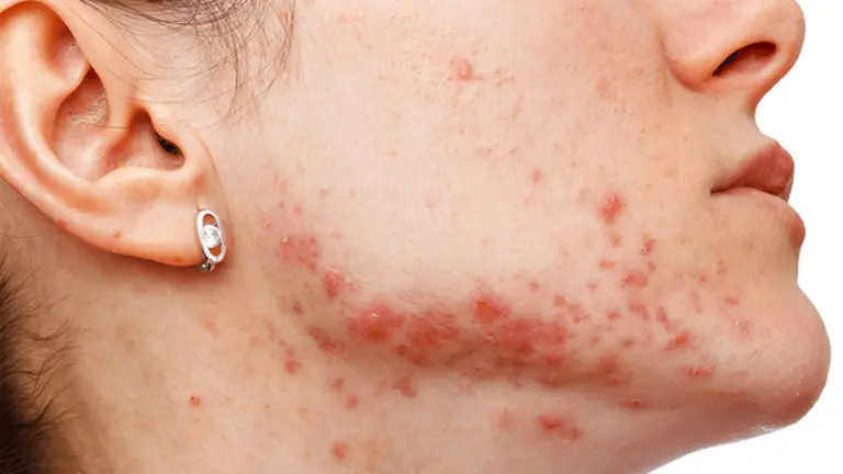 Imagen de una paciente con Hidradenitis ARCHIVO