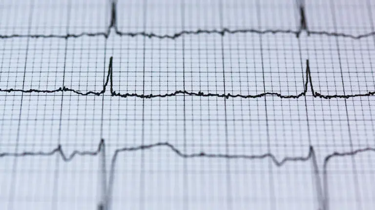 Imagen de un electrocardiograma. ARCHIVO