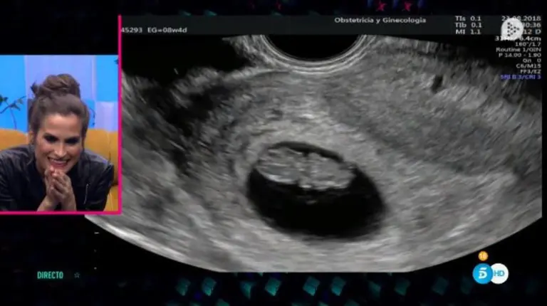 La navarra Estefanía Unzu observa una de sus primeras ecografía del séptimo hijo que espera dentro del concurso Gran Hermano VIP Foto TELECINCO