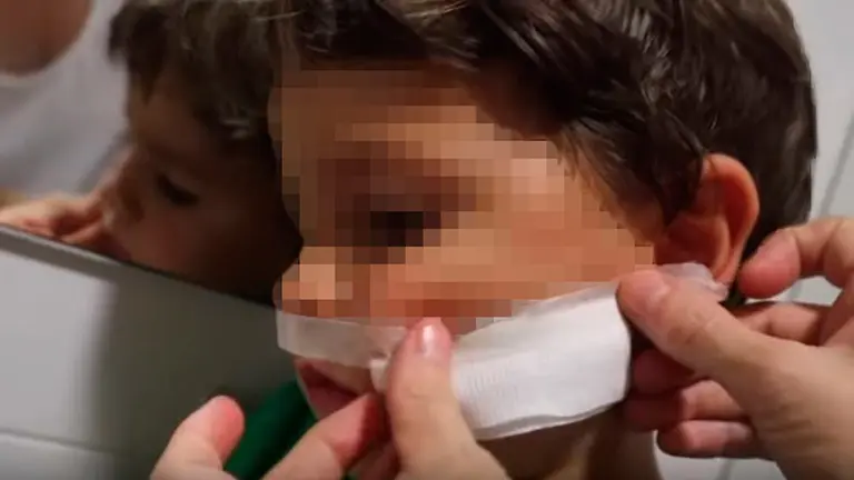 Verdeliss coloca un apósito a su hijo Julen después de quemarse la cara con el horno. YOUTUBE