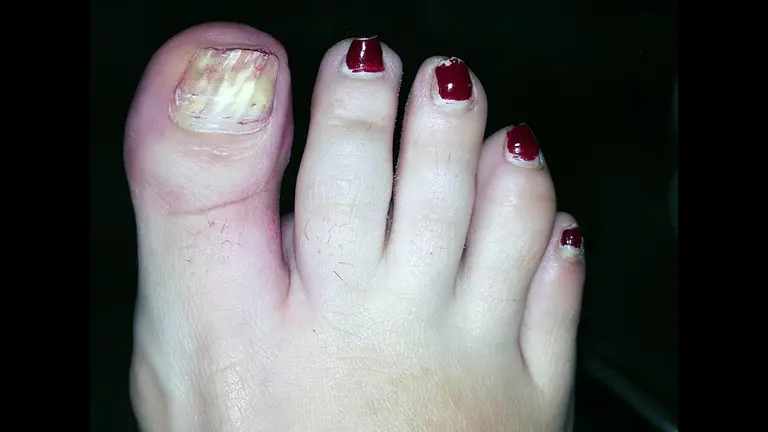 Onicodistrofia total provocada por micosis ungueal que aparece al retirar el esmalte permanente. CEDIDA