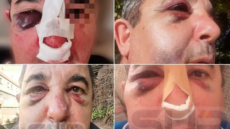 Evoluci&oacute;n sanitaria del agente de Tudela agredido brutalmente en Zaragoza. SUP NAVARRA