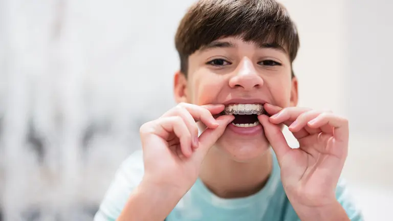 Un niño se coloca un aparato invisible para cuidar su salud dental. SHUTTERSTOCK