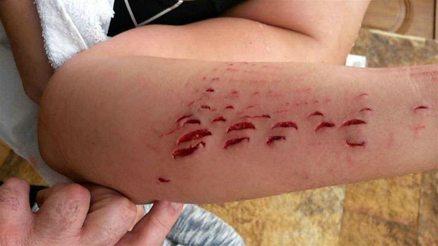 Ataque de tiburón a una turista madrileña. EP