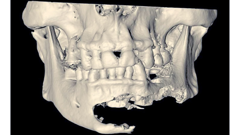 La cirugía virtual y la impresión de modelos en 3D en la cirugía maxilofacial EP.