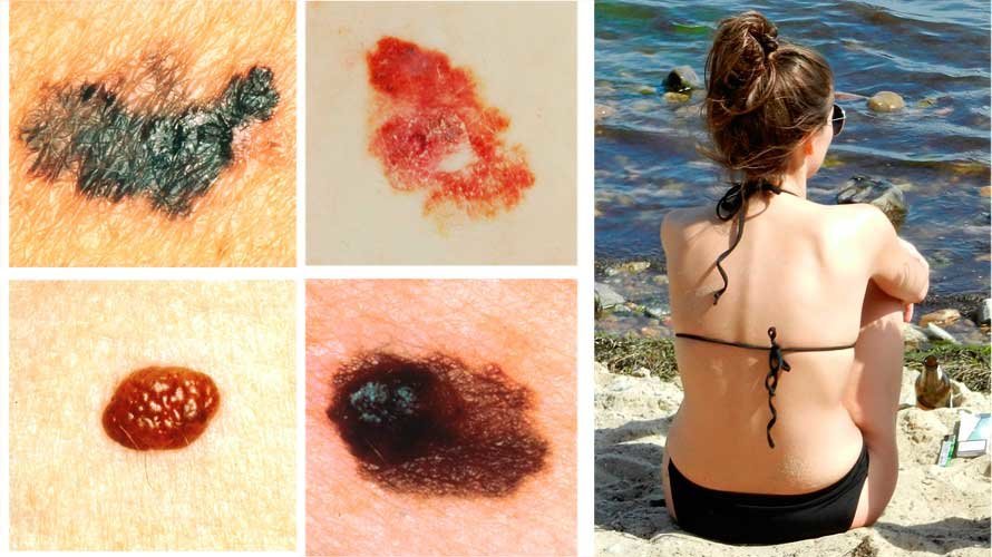 Varios tipos de manchas que pueden aparecer en la piel y una joven tomando el sol en la playa. ARCHIVO