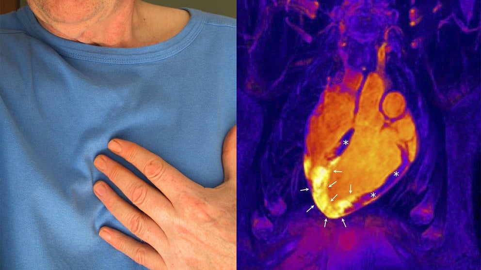 Descubren una nueva teoría sobre la reacción del corazón tras un infarto