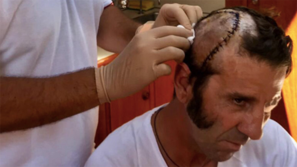 El torero Juan José Padilla recibe las curas en su herida en la cabeza donde le pusieron 50 grapas tras ser cogido en Arévalo TWITTER