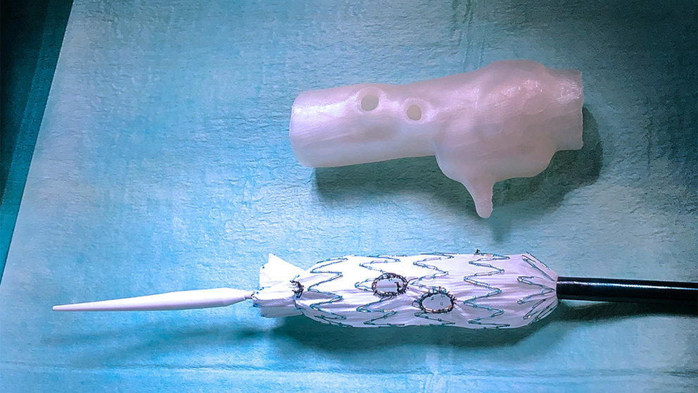 Endoprótesis personalizada implantada en el CHN según modelo 3D. GOBIERNO DE NAVARRA