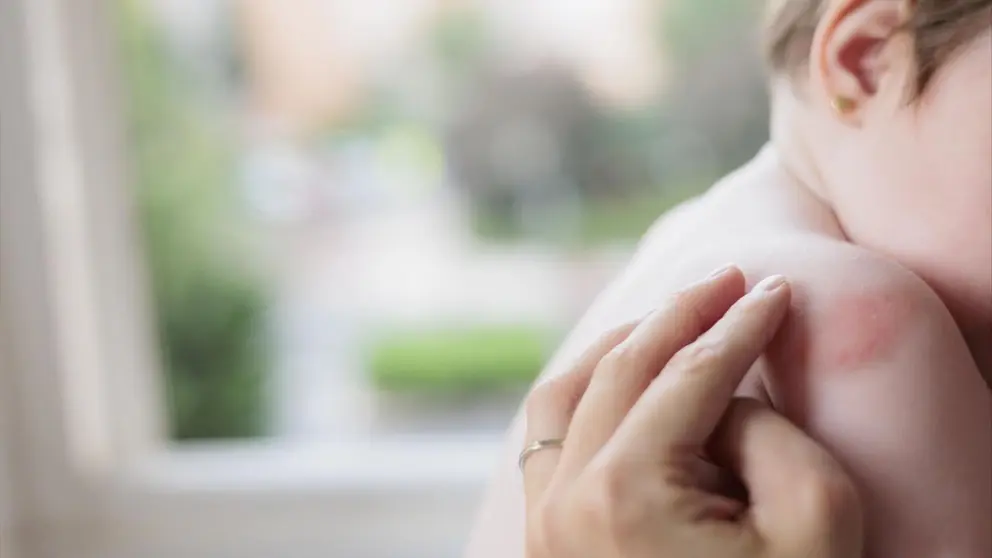 La dermatitis es una inflamación de la piel que puede presentarse con enrojecimiento o picazón. CEDIDA