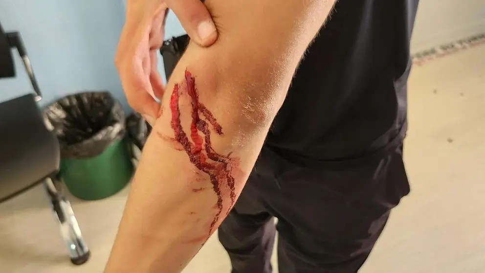 Víctima de delito de lesiones con arma blanca. POLIC&Iacute;A LOCAL DE TUDELA
