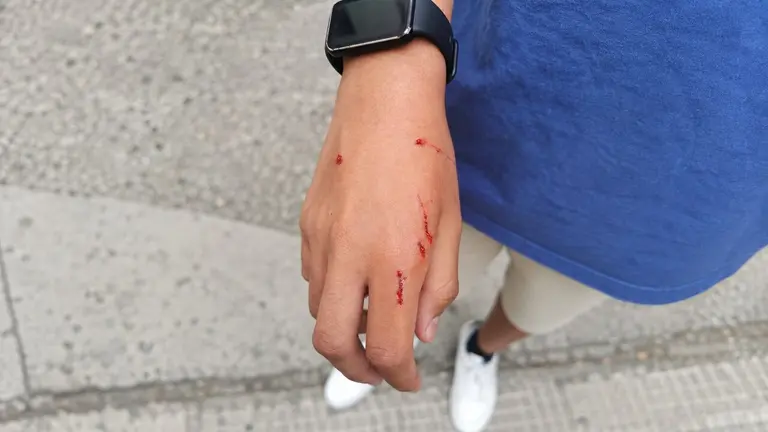 Imagen de las lesiones del chico mordido por el perro en Tudela.