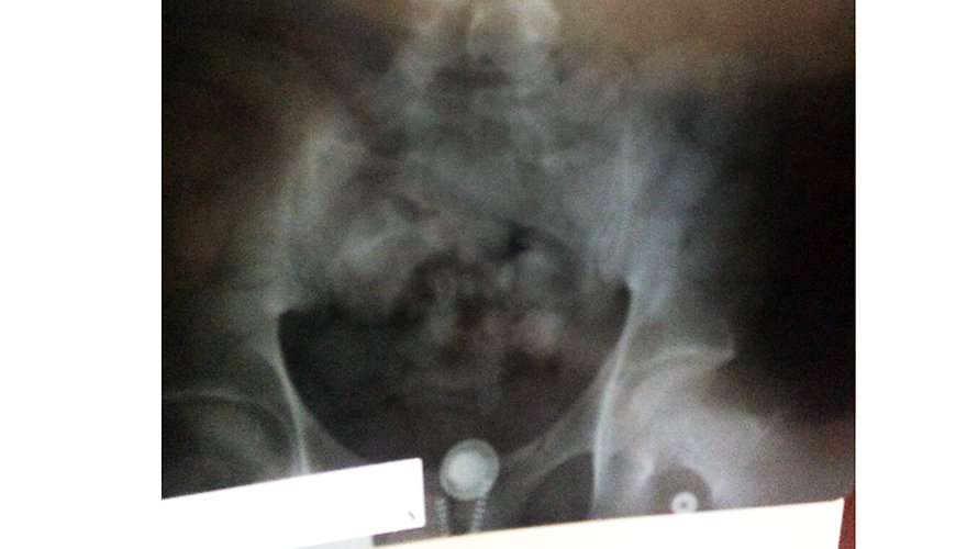 Radiografía de la persona que portaba la cocaína en su interior