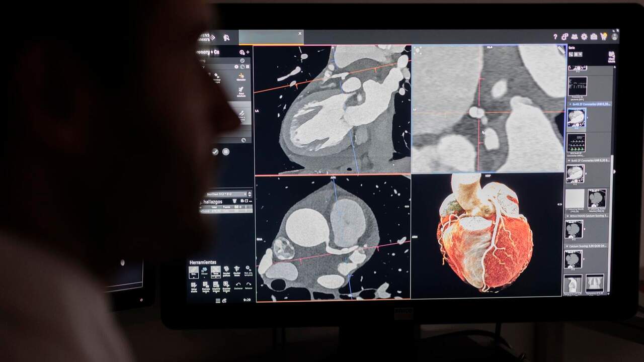Así funciona el nuevo escáner de la Clínica Universidad de Navarra que detecta con más precisión el riesgo de infarto